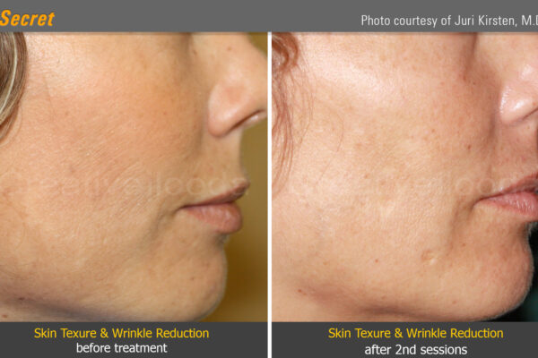 10. Skin Texure _ Wrinkle Reduction